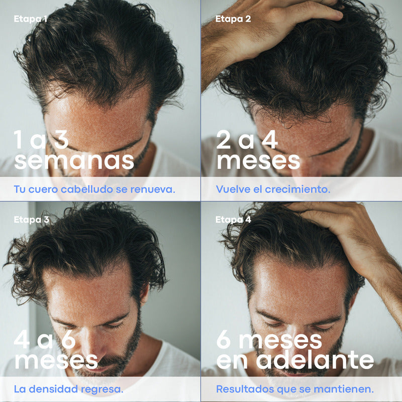 Minoxidil Anacastel 5% Solución Tratamiento Cabello Anticaida Capilar, Crecimiento Cabello Y Crecimiento De Barba Minoxidil Topico (2, 3 Y 6 Pack)