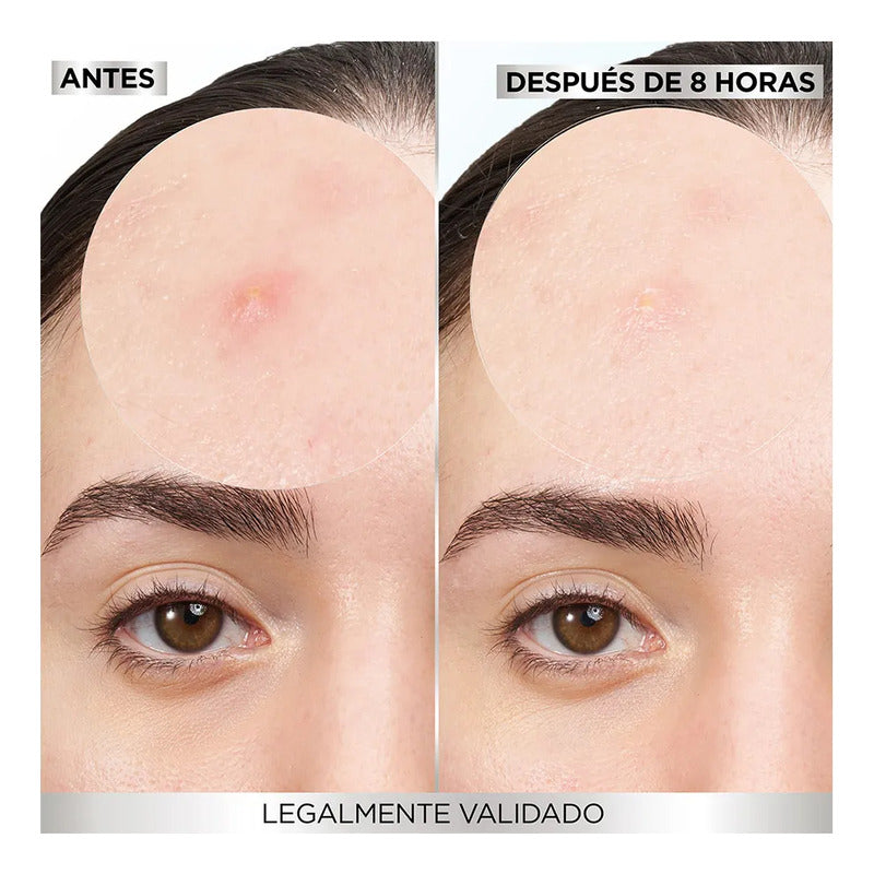 Garnier Pimple Patch Invisible 22 Pz Diferentes Tamaños - Todo Tipo De Piel - Día/noche