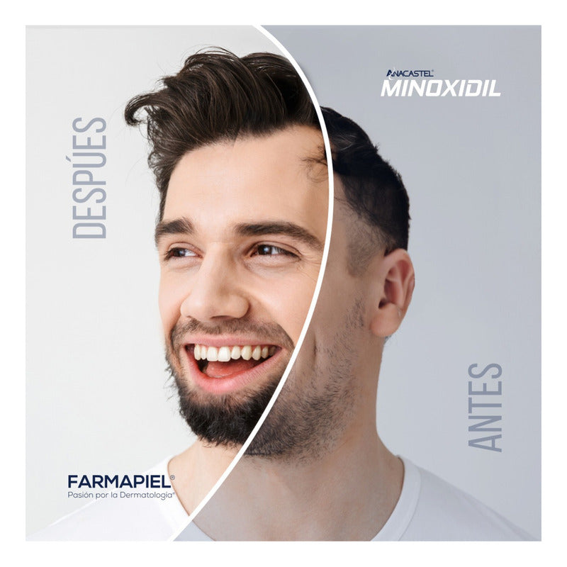 Minoxidil Anacastel 5% Solución Tratamiento Cabello Anticaida Capilar, Crecimiento Cabello Y Crecimiento De Barba Minoxidil Topico (2, 3 Y 6 Pack)