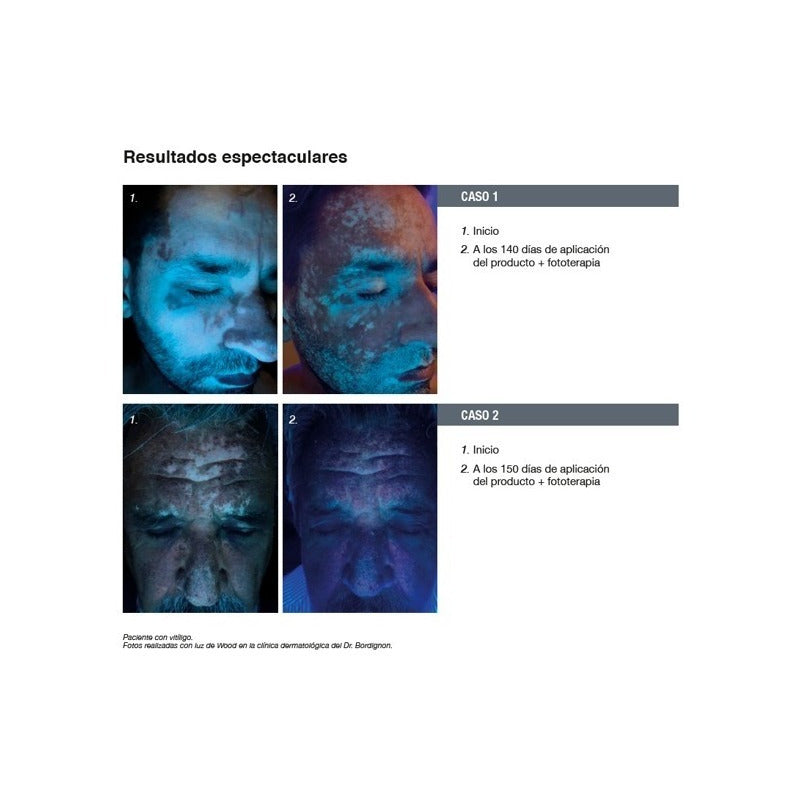 Repigment12 Tratamiento Para Pieles Con Hipopigmentacion Momento De Aplicación Día/noche Tipo De Piel Todo Tipo De Piel